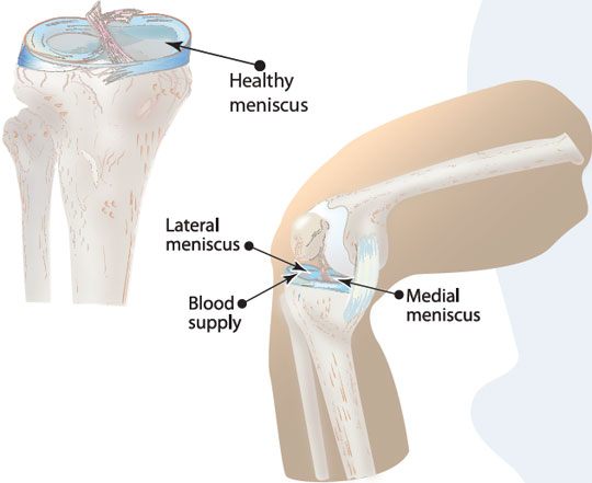 Meniscus Tears
