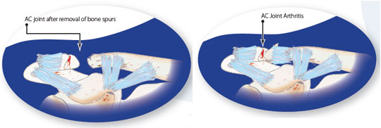 AC Joint Injuries
