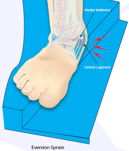 Eversion Ankle Sprain