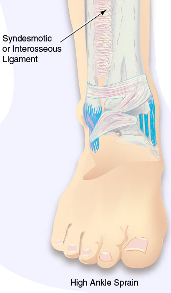 High Ankle Sprain