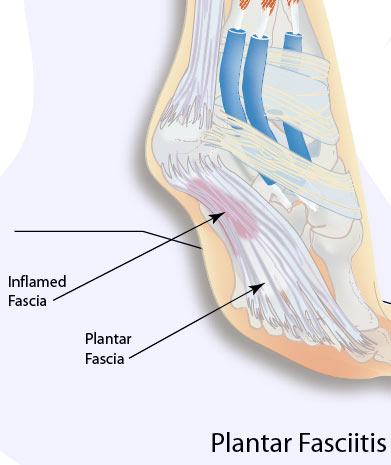 plantar fasciitis shoes