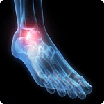 Plantar Fasciitis,Pes Planus,Mallet Toe,High Arched Feet,Heel Spur,Heel Pain,Hammer Toe,Hallux Valgus,Foot Pain,Foot Hard Skin,Foot Conditions,Foot Callous,Flat Feet,Fallen Arches,Diabetic Foot,Contracted Toe,Claw Toe,Bunions Hard Skin,Bunions Callous,Bunion Pain,Ball Of Foot Pain,Back Pain