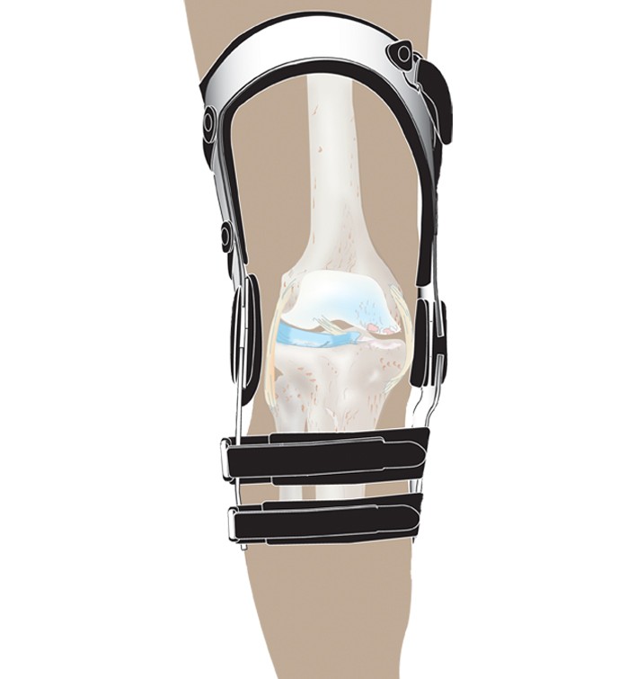 DonJoy OAdjuster Osteoarthritis Knee Brace