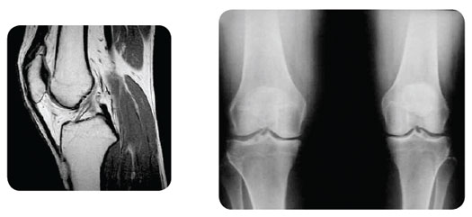 treatment for osteoarthritis of the knee