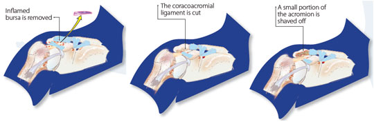 Shoulder Impingement Surgery Needed