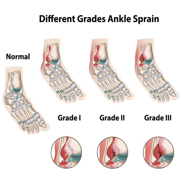 3 grades of ankle sprains