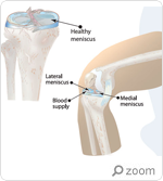 Meniscus Injuries